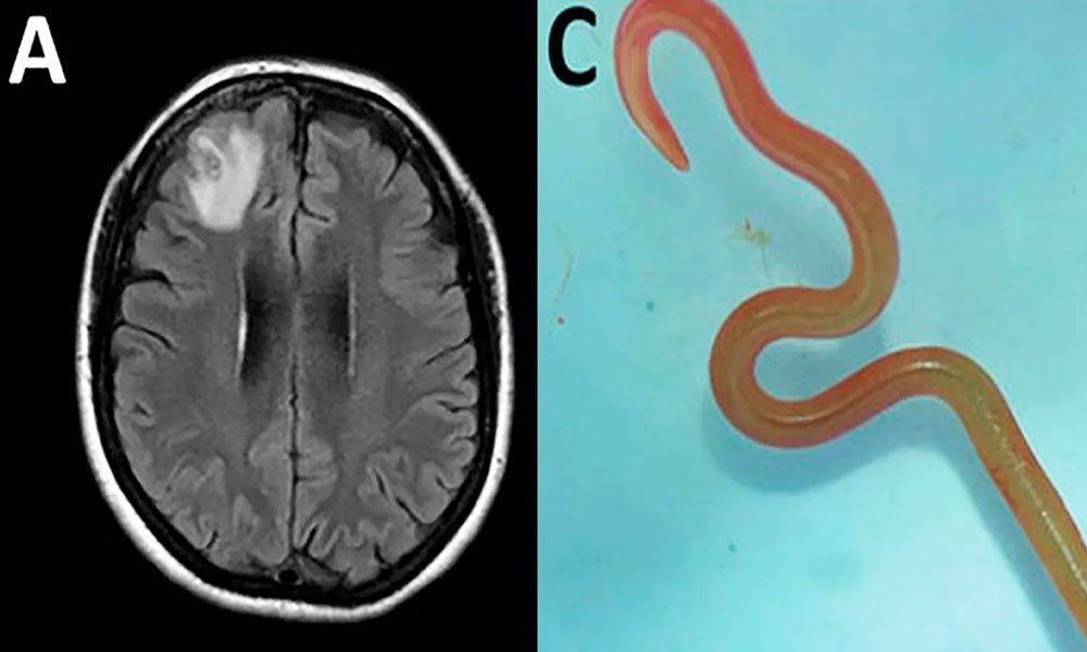 Detection of Ophidascaris robertsi nematode infection in a 64-year-old woman from southeastern New South Wales, Australia.