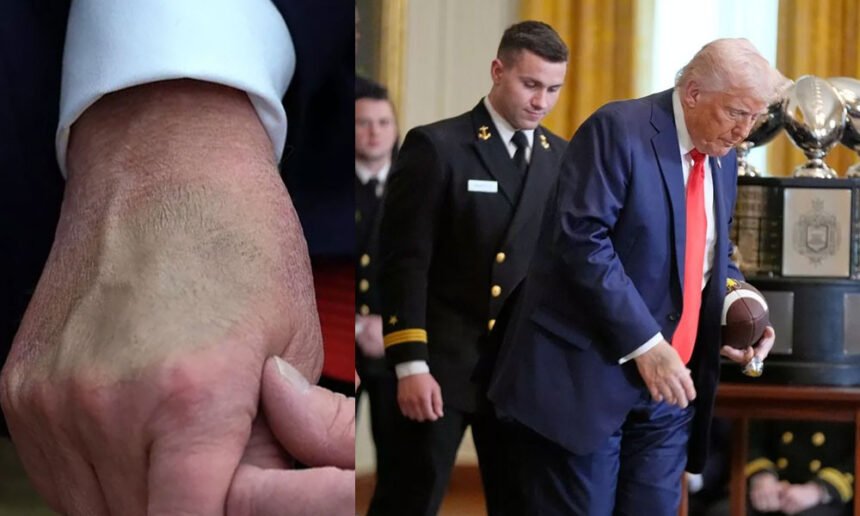 Trump’s Mysterious Hand Bruise Reappears During Navy Trophy Presentation as Health Speculation Grows