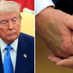 Mysterious Bruise on Trump’s Right Hand Reappears, Raising Fresh Health Concerns