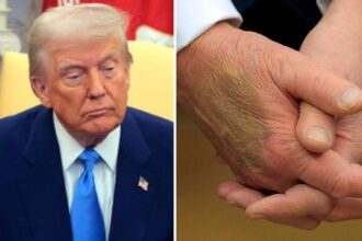 Mysterious Bruise on Trump’s Right Hand Reappears, Raising Fresh Health Concerns