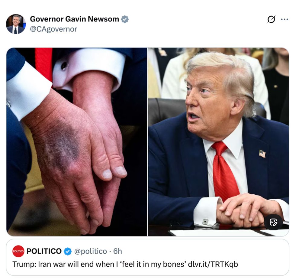 Newsom Taunts Trump With Photo of Bruised Hand After ‘Bones’ Remark on Iran War