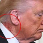 'Shingles?': Internet Reacts After Photographers Capture Nasty-Looking Rash on Trump's Neck