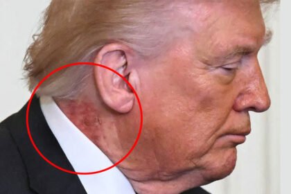 'Shingles?': Internet Reacts After Photographers Capture Nasty-Looking Rash on Trump's Neck
