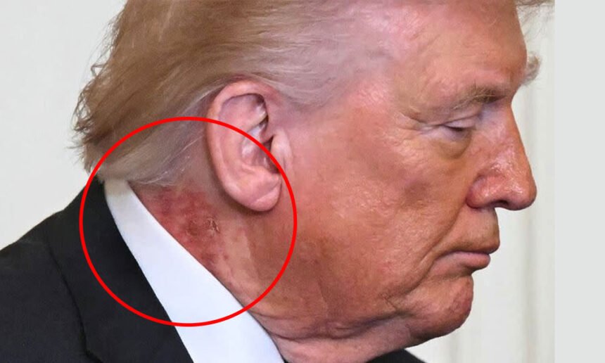 'Shingles?': Internet Reacts After Photographers Capture Nasty-Looking Rash on Trump's Neck